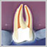 Root Canal